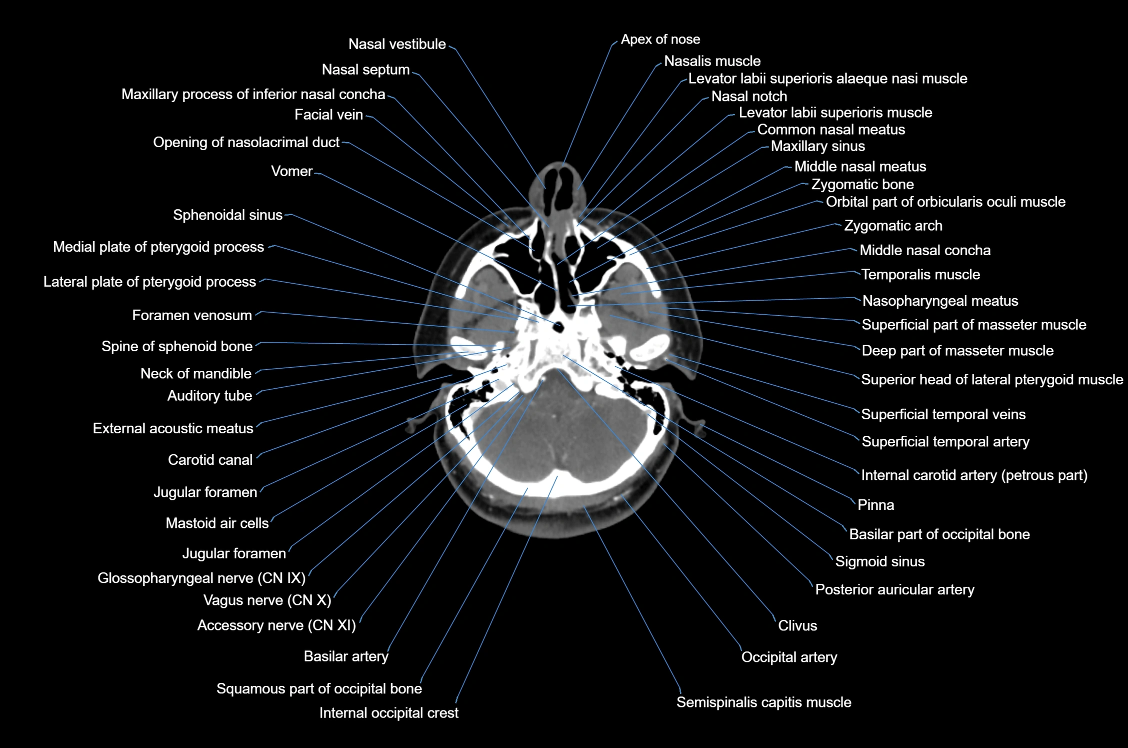 CT Neck axial cross sectional anatomy radiology image-img-00001-00015.webp